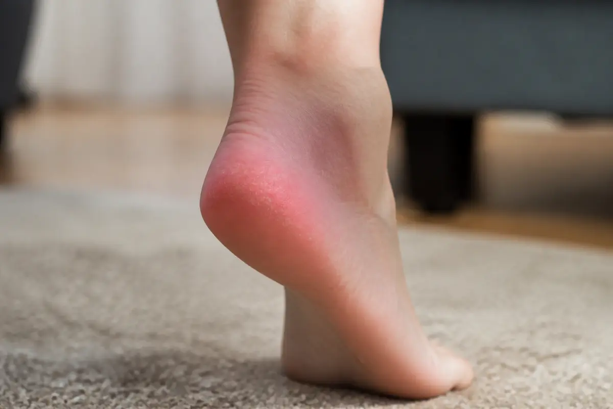 Talons rouges et gonflés, symptômes potentiels de douleur au talon liée au cancer