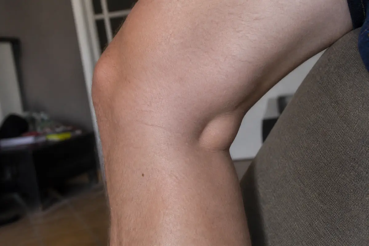 Genou plié sur canapé montrant douleur derrière le genou