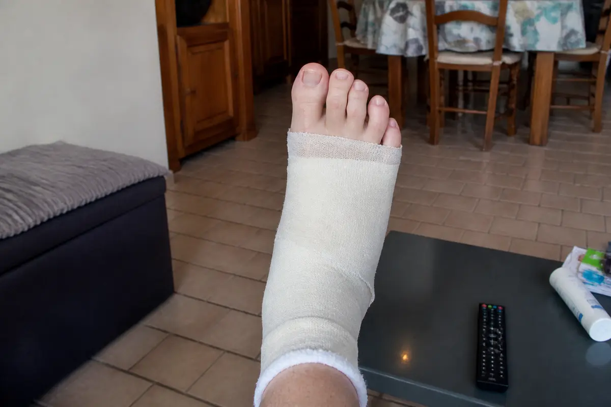 Temps de consolidation de la fracture du 5ème métatarse : Durée &amp; soins